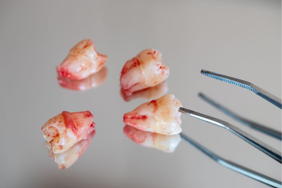 wisdom tooth removal