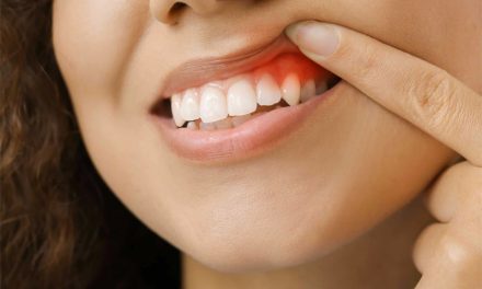 The Ultimate Guide: How to Cure Gum Disease Without a Dentist