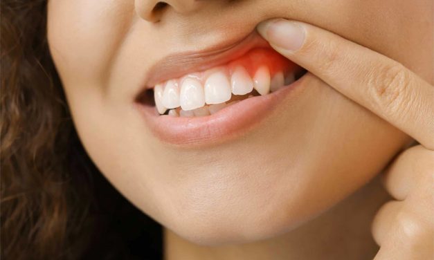 The Ultimate Guide: How to Cure Gum Disease Without a Dentist